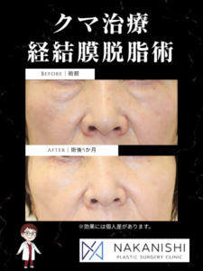 クマ治療の経過|経結膜脱脂術・術後5か月の症例